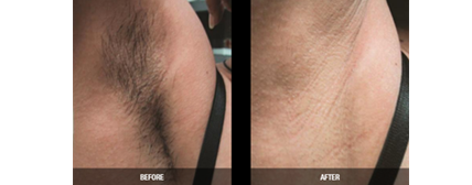 A before and after image of laser hair removal near Palm Shores, FL
