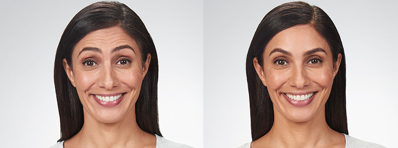 A woman before and after Botox injections in Melbourne, FL