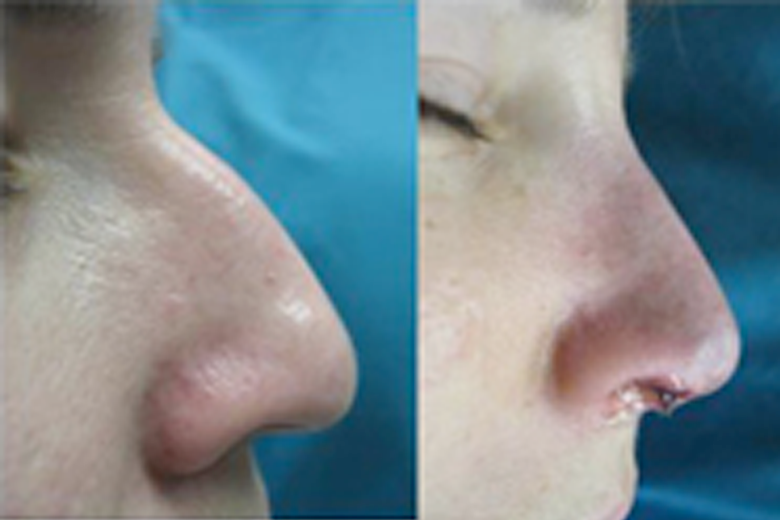 Rhinoplasty-Dr-Antony-1