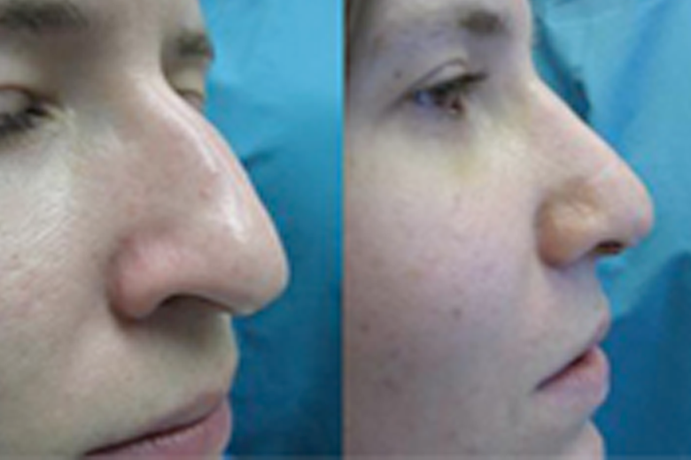 Rhinoplasty-Dr-Antony-2