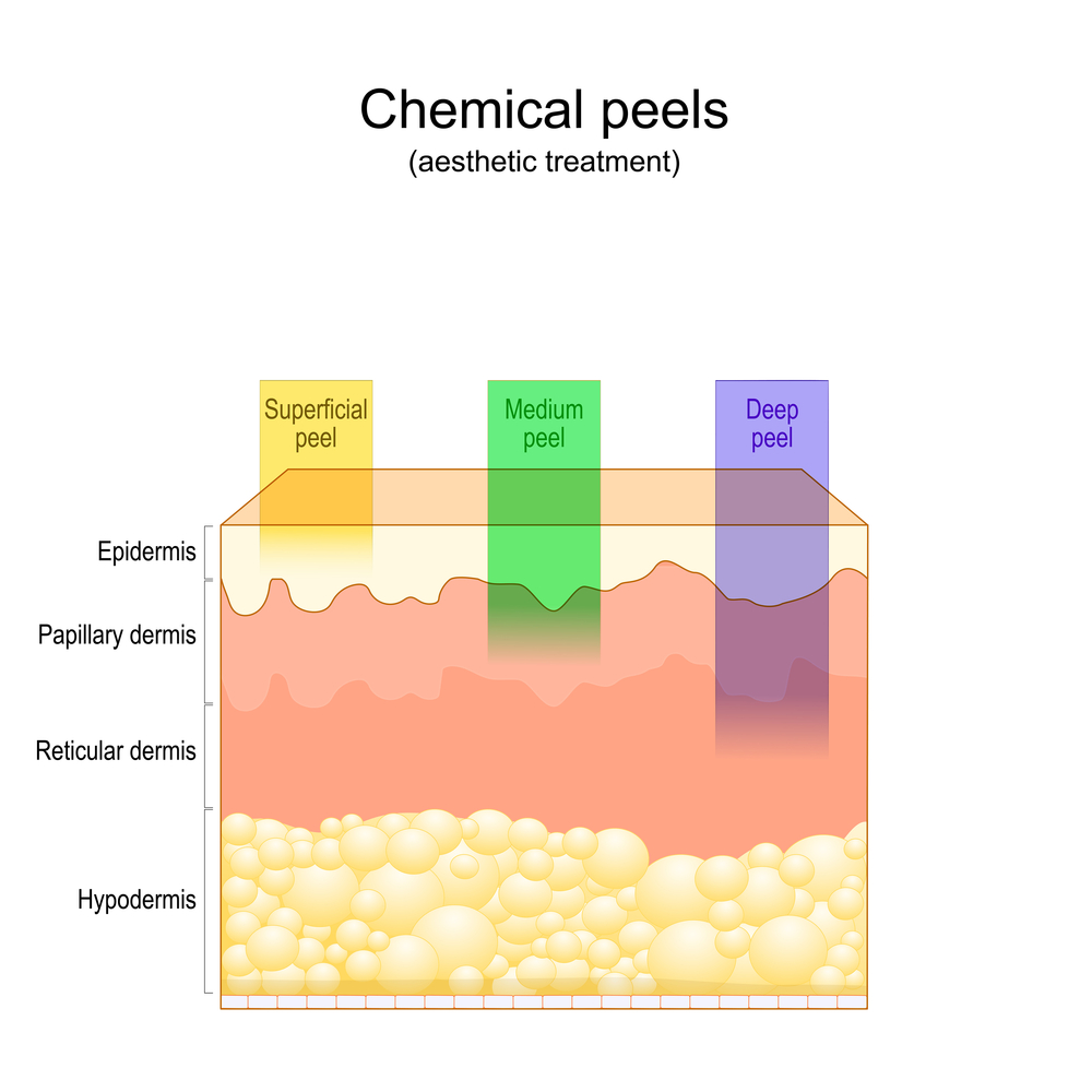 chemical peel