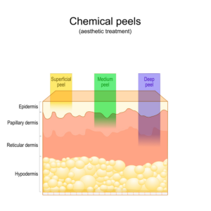 chemical peels