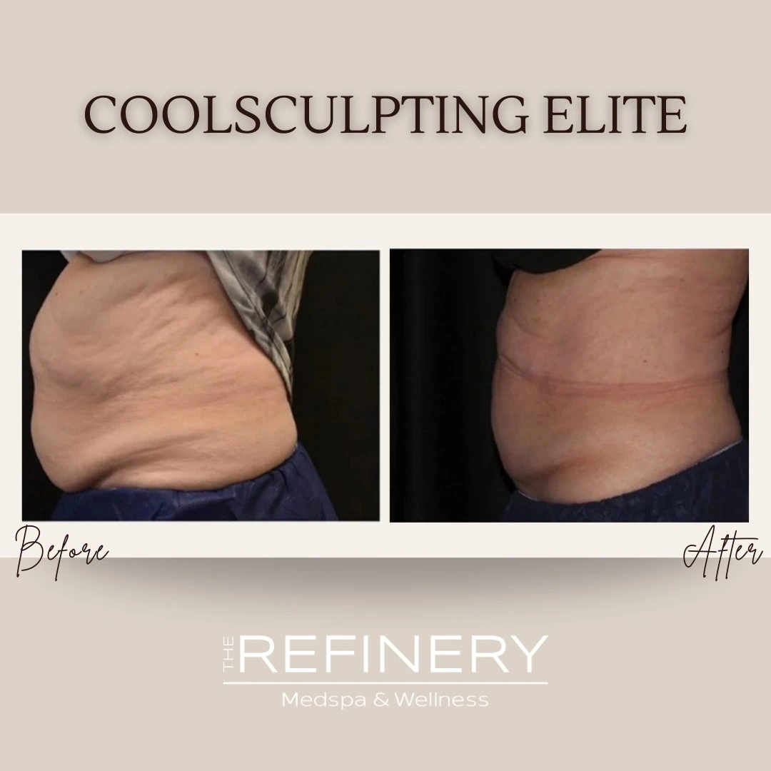 CoolSculpting Elite before and after