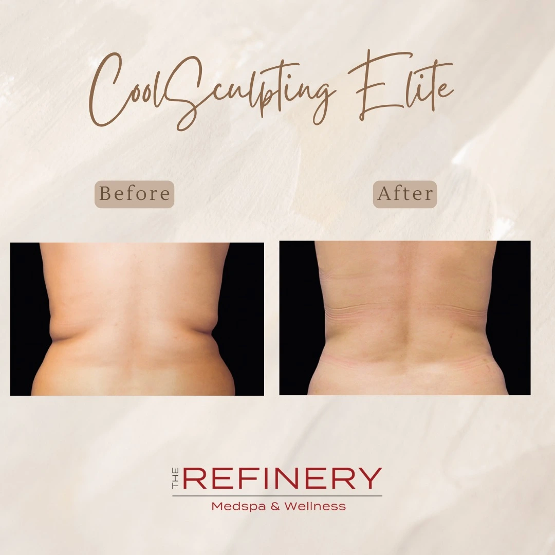 CoolSculpting result - west melbourne and palm bay