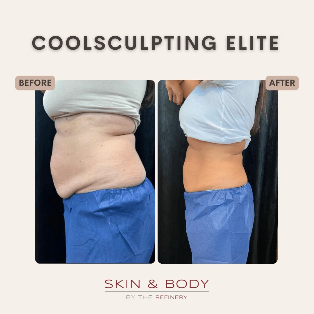before and after of a CoolSculpting® Elite treatment