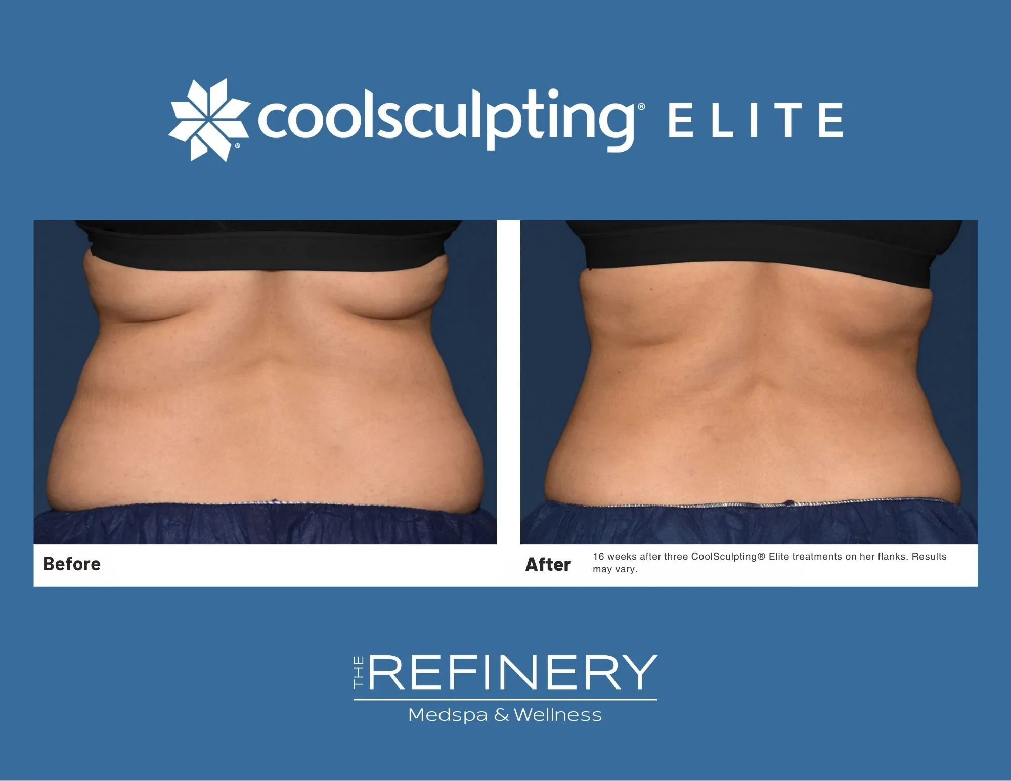 After three CoolSculpting® Elite treatments
