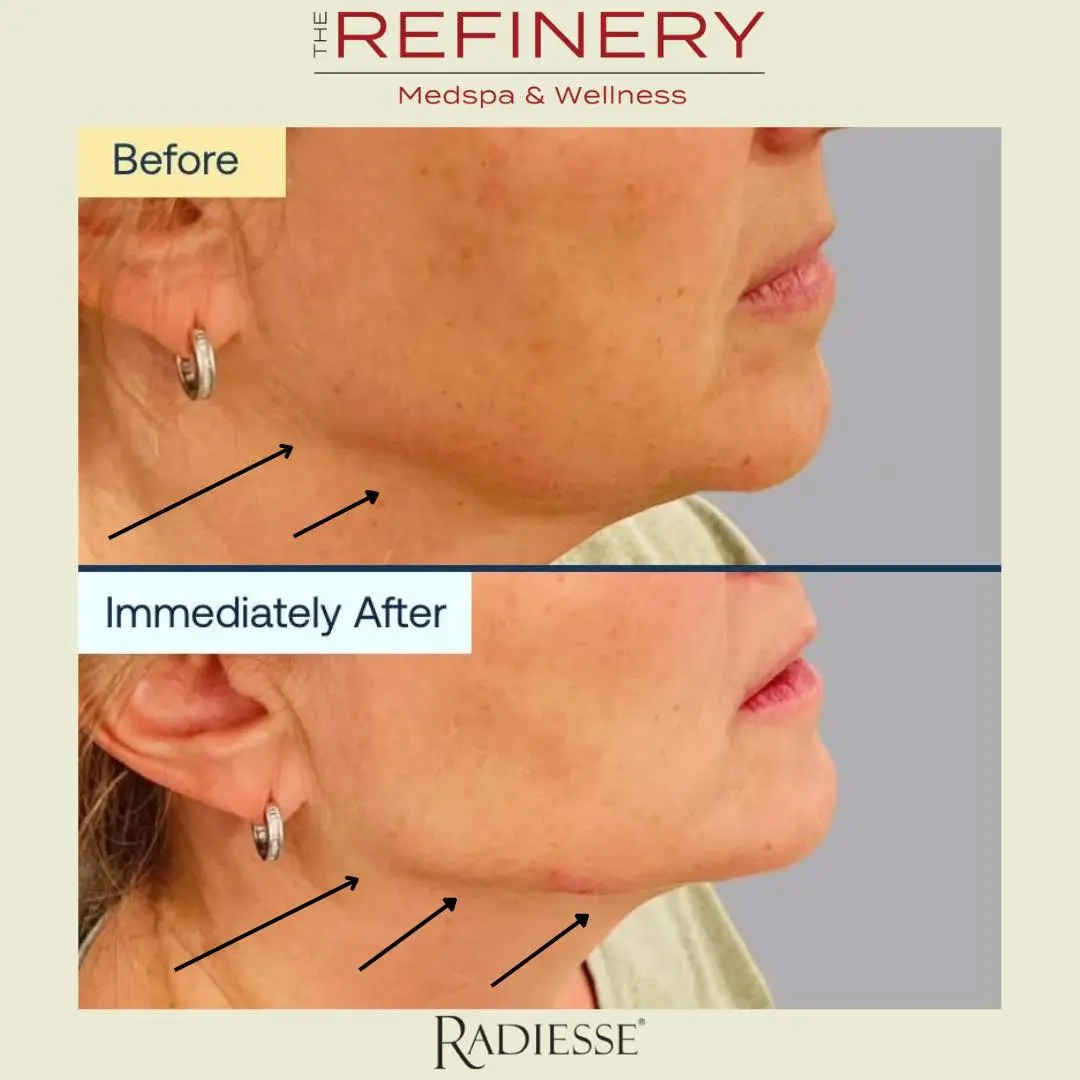 Radiesse before and after | West Melbourne and Indian Harbour Beach FL