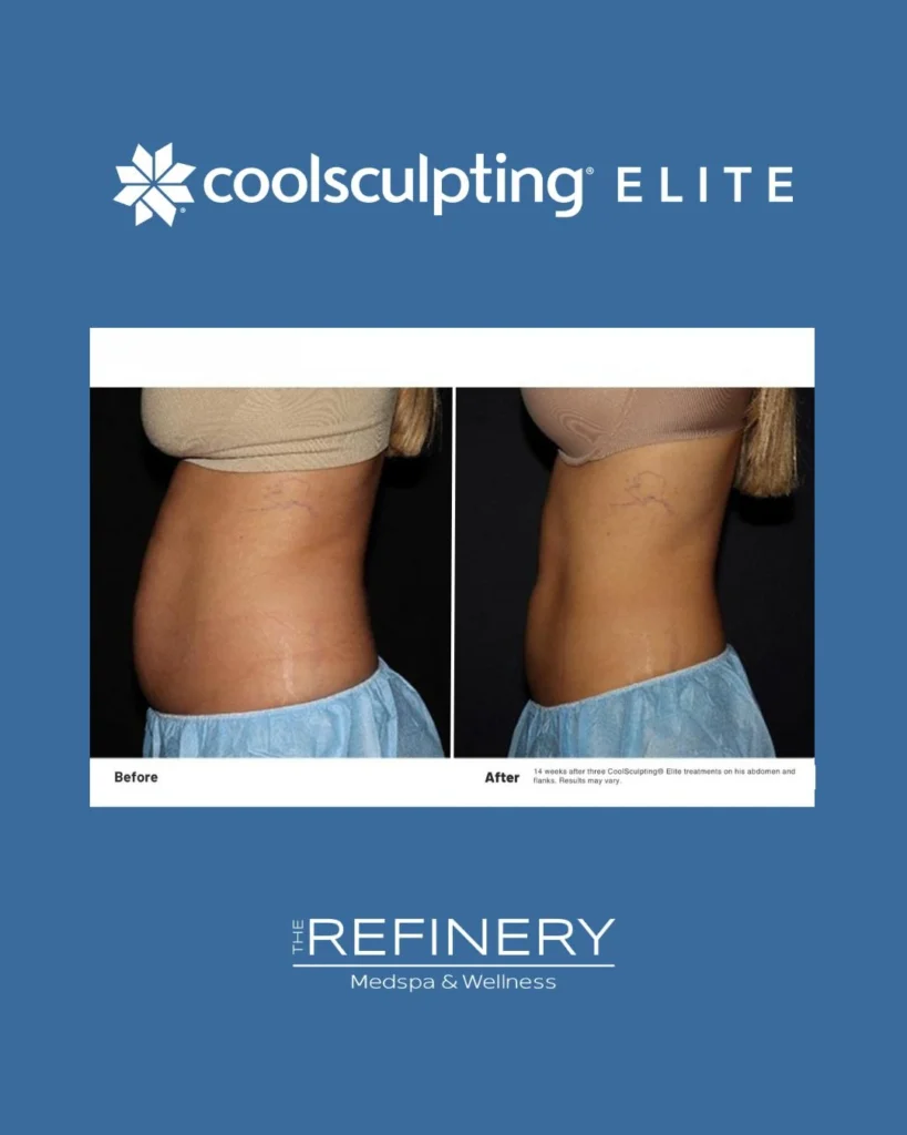 CoolSculpting® Elite treatment