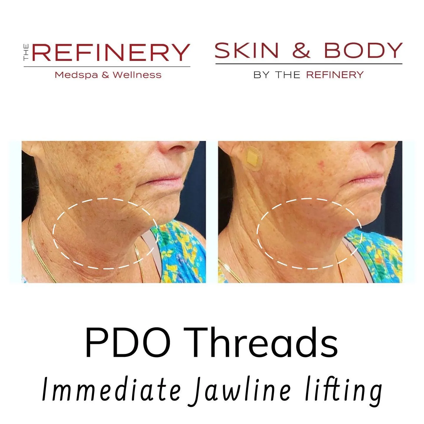 PDO threads before and after