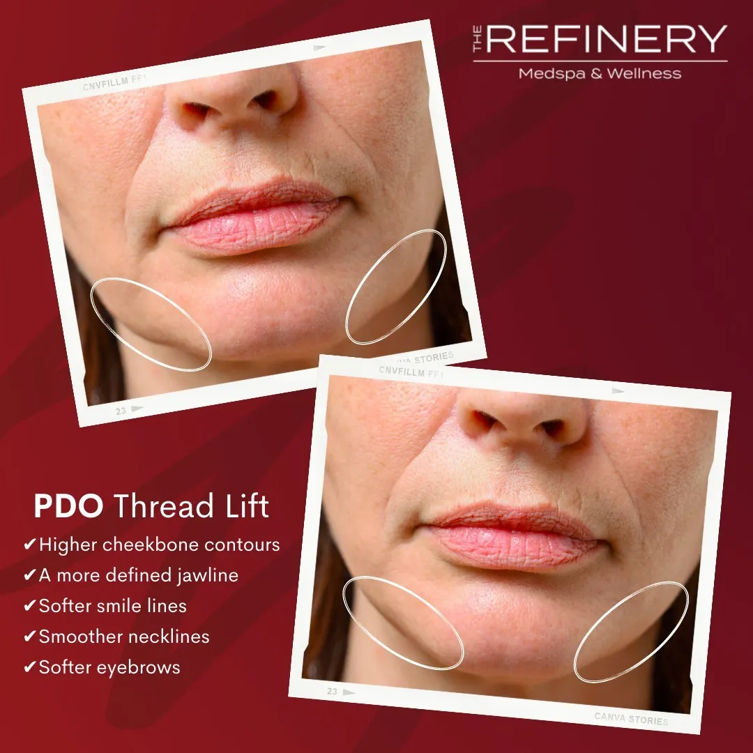 pdo thread lift | west melbourne and palm bay fl