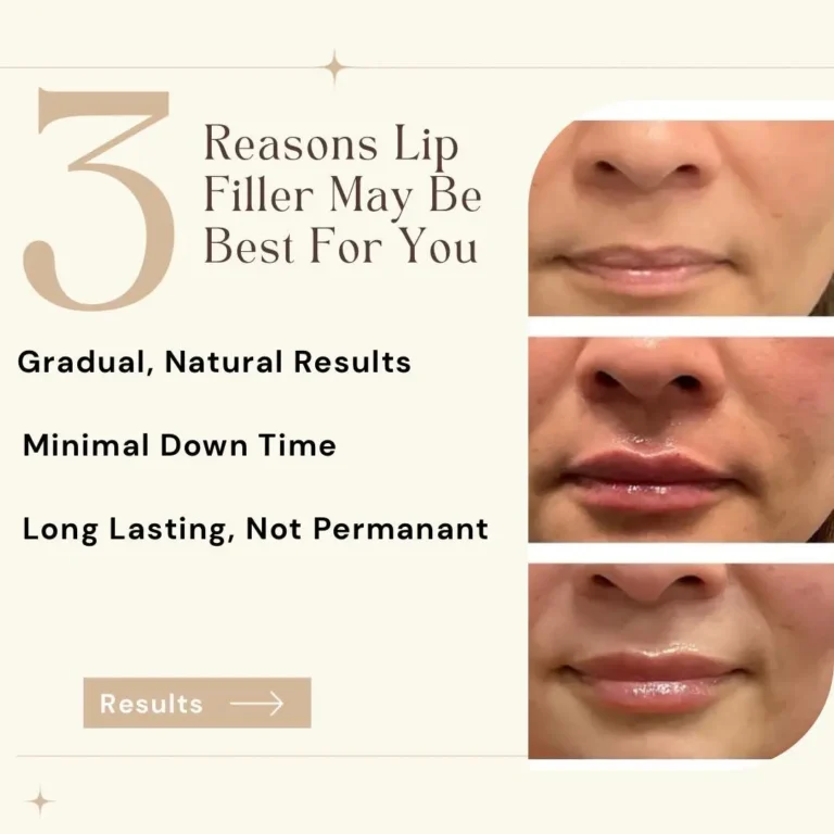 lip filler results