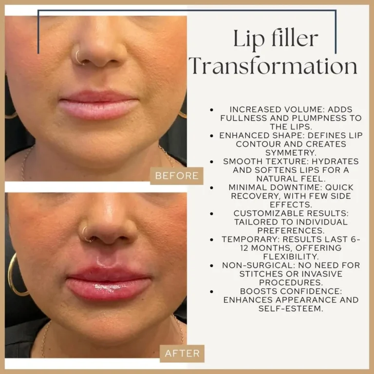 lip filler transformation